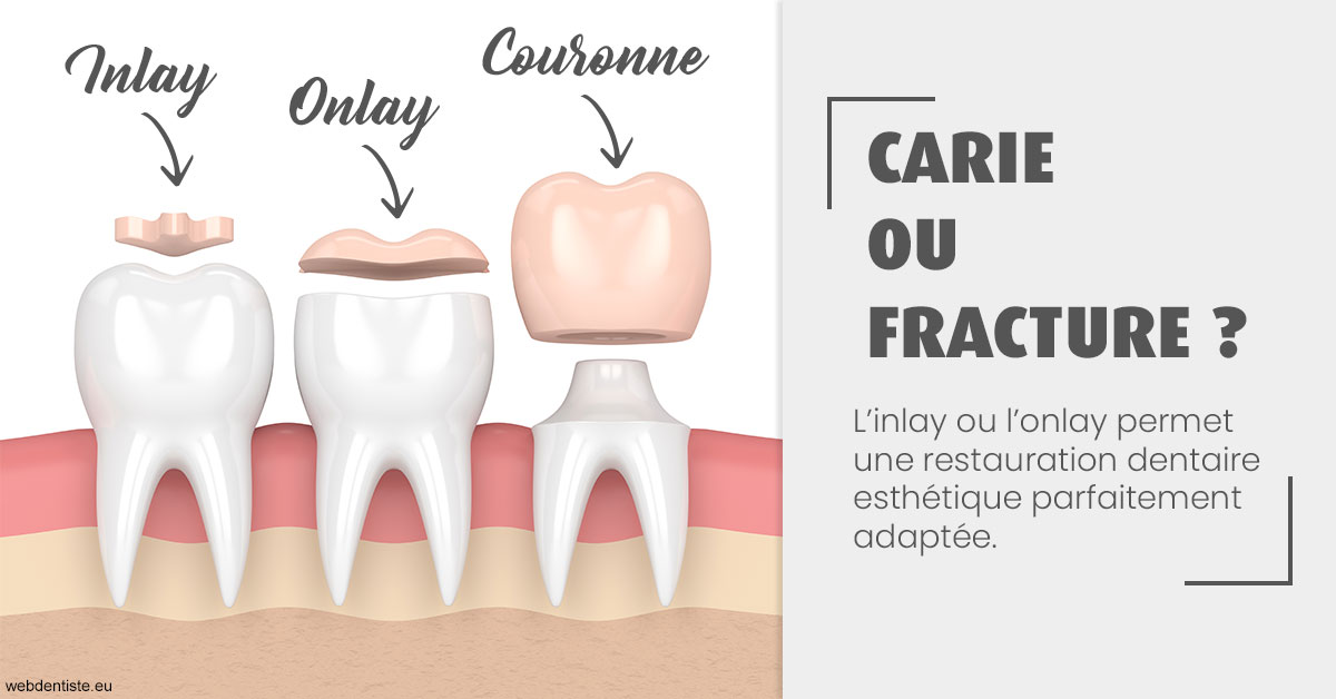 https://www.dr-vincent-stephane.fr/T2 2023 - Carie ou fracture 1
