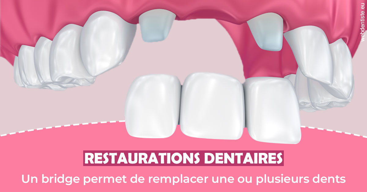 https://www.dr-vincent-stephane.fr/Bridge remplacer dents 2